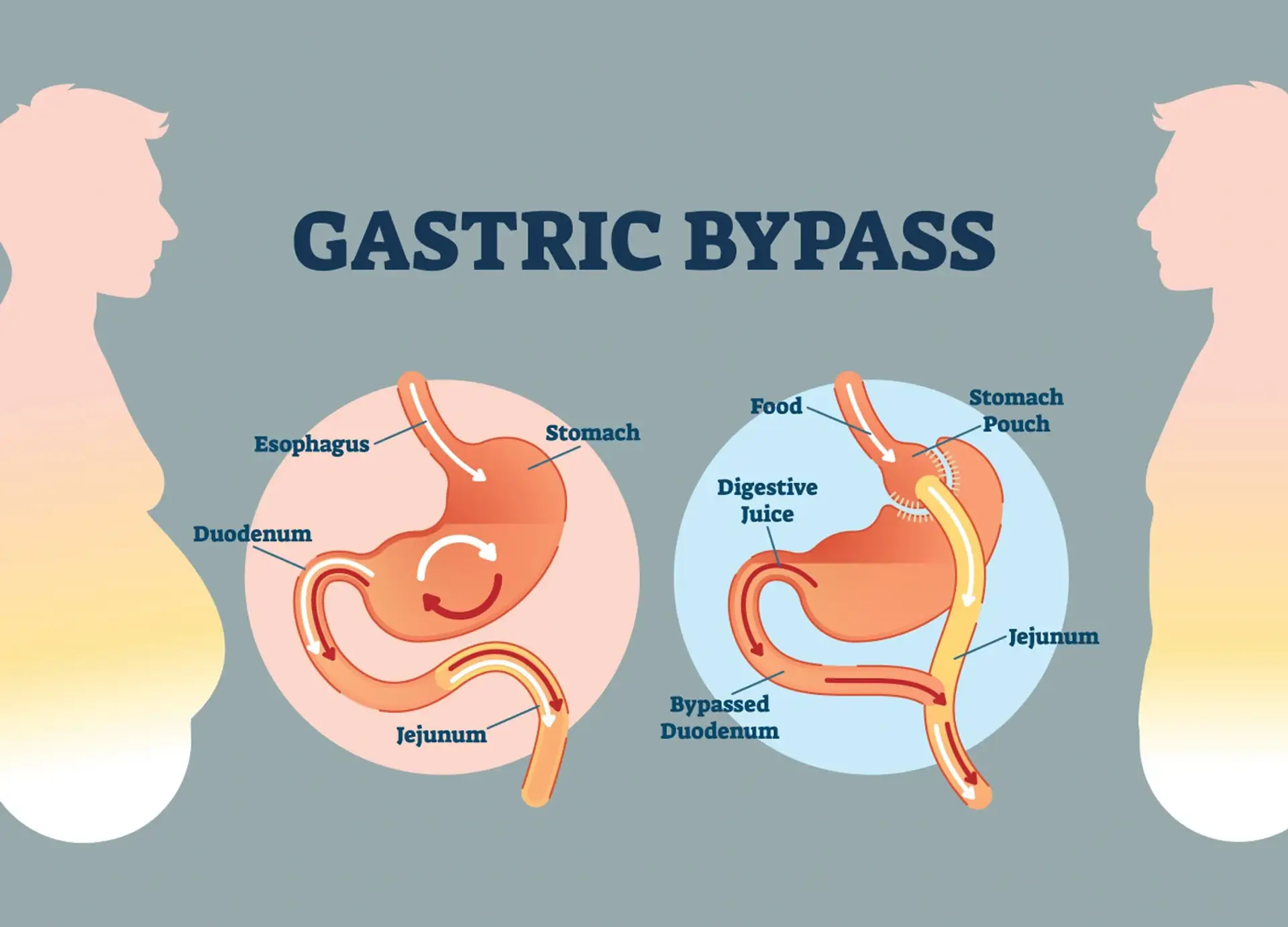 obesidad-alternativas-a-la-cirugía-de-bypass-gástrico