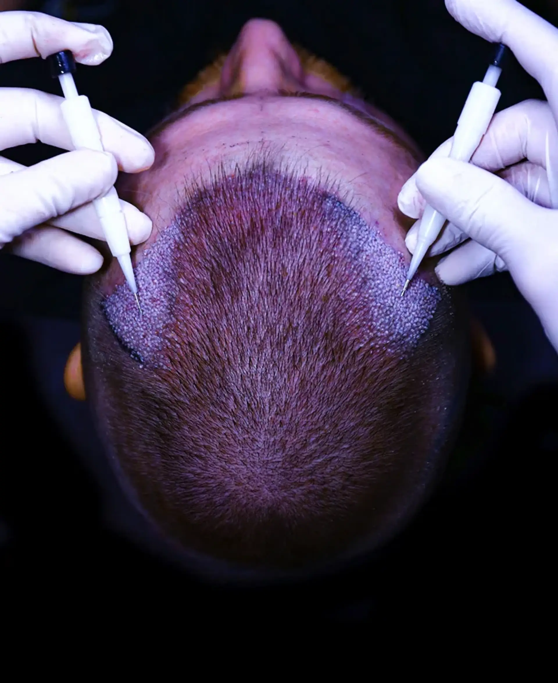 benefits-of-hair-transplant