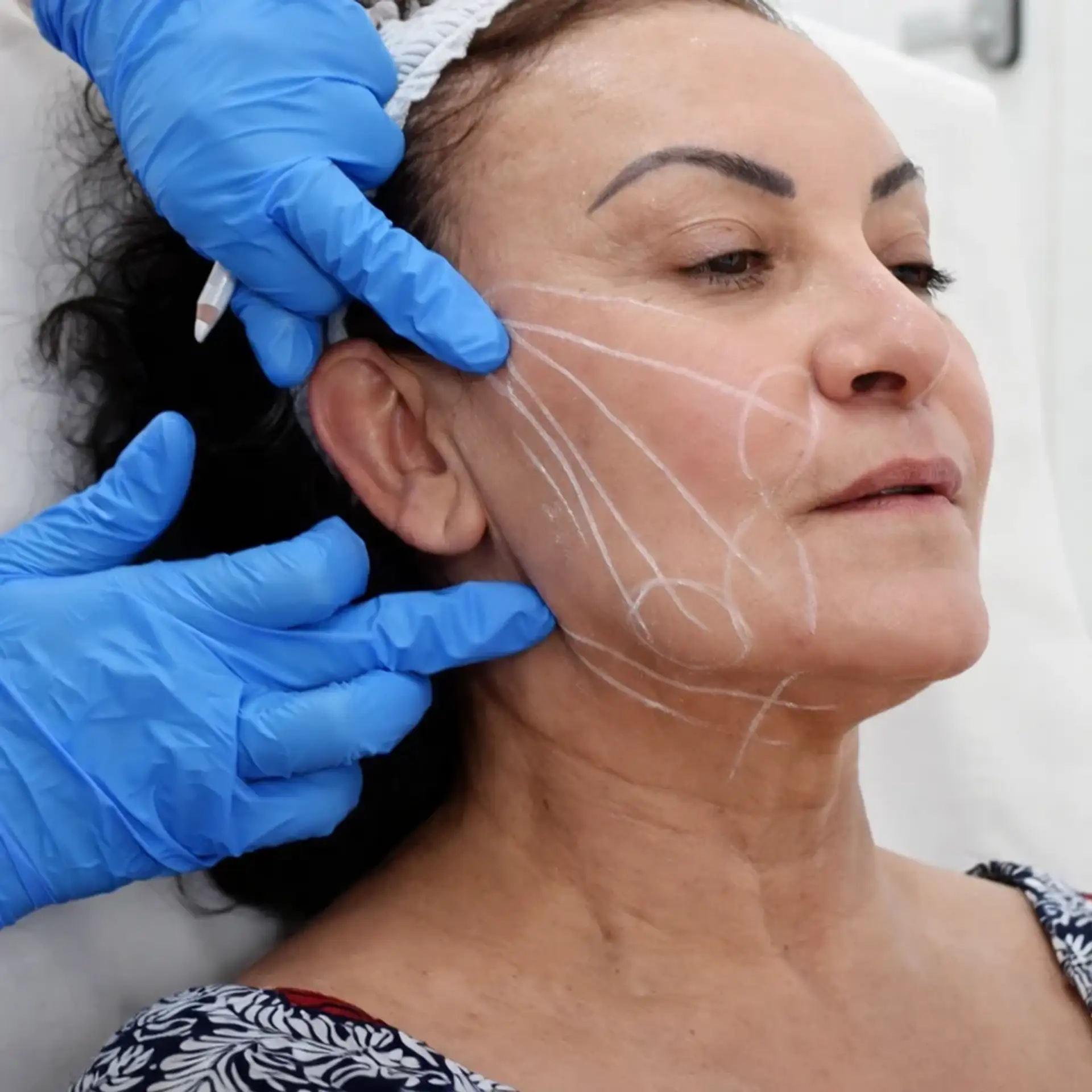 o que é facelift-peru