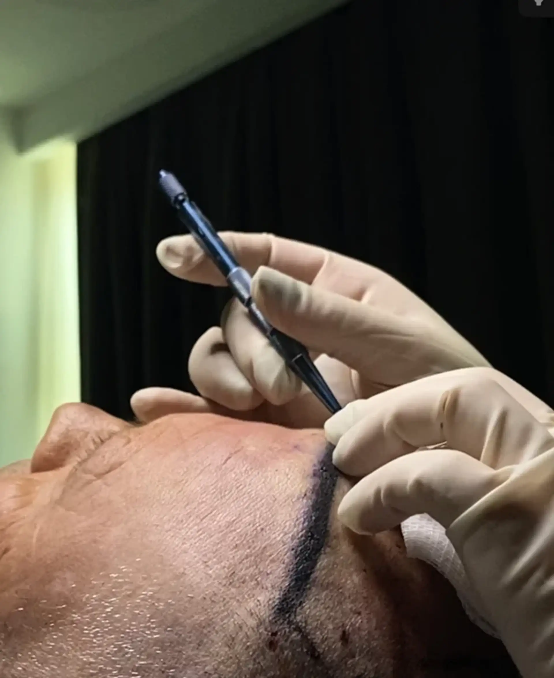 why-choose-tirana-for-hair-transplant