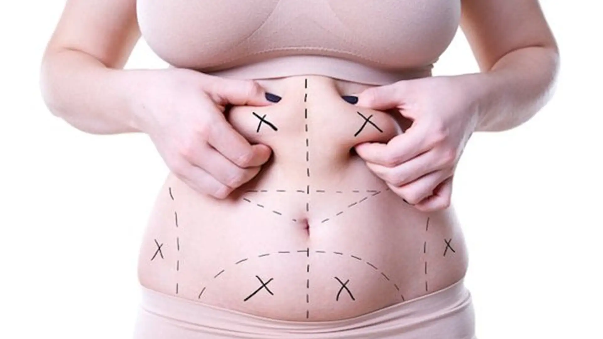 mega-liposukcja-czego się spodziewać w dniu-wysokiego-bmi-liposukcja-chirurgii