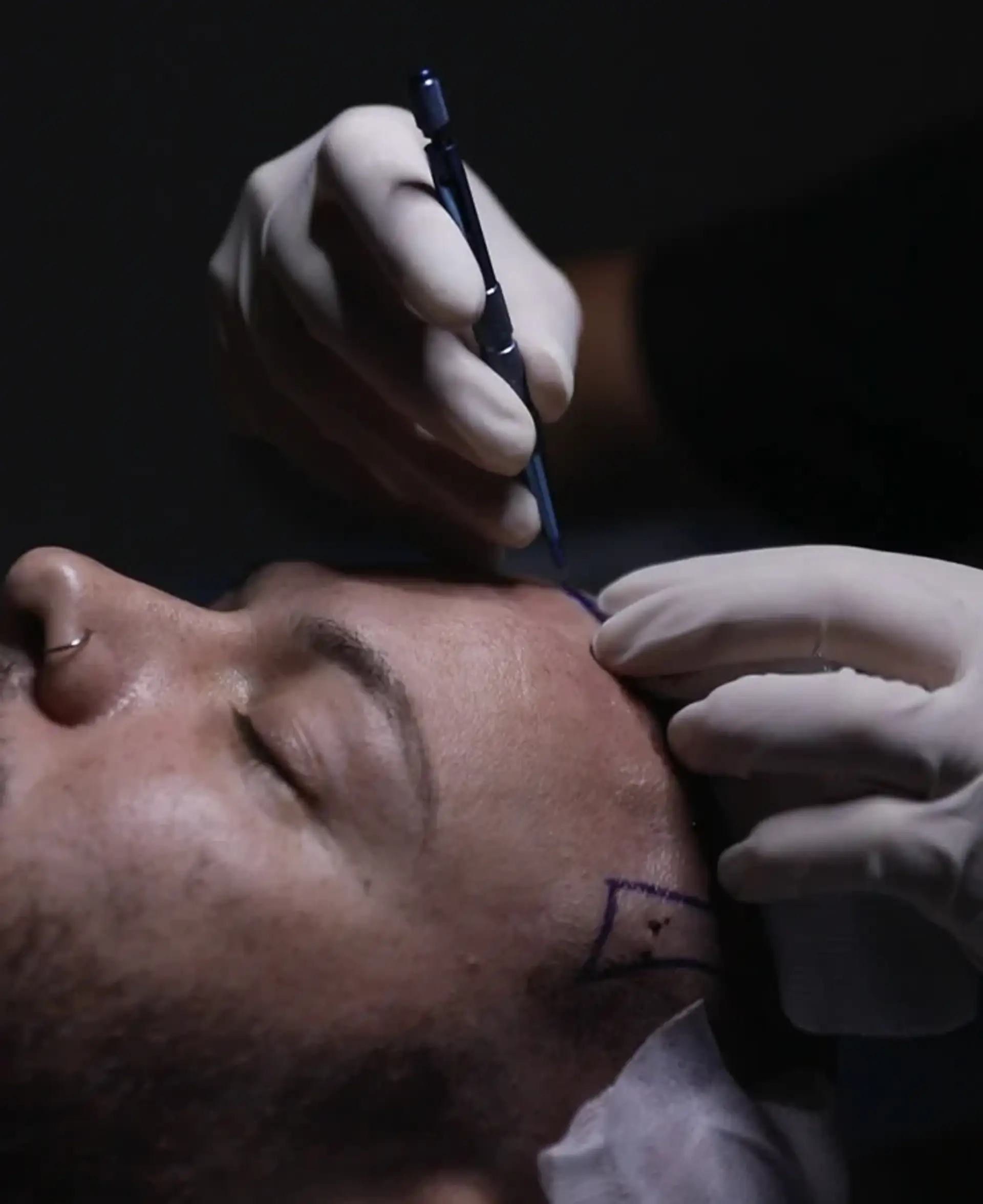 hair-transplant-in-albania