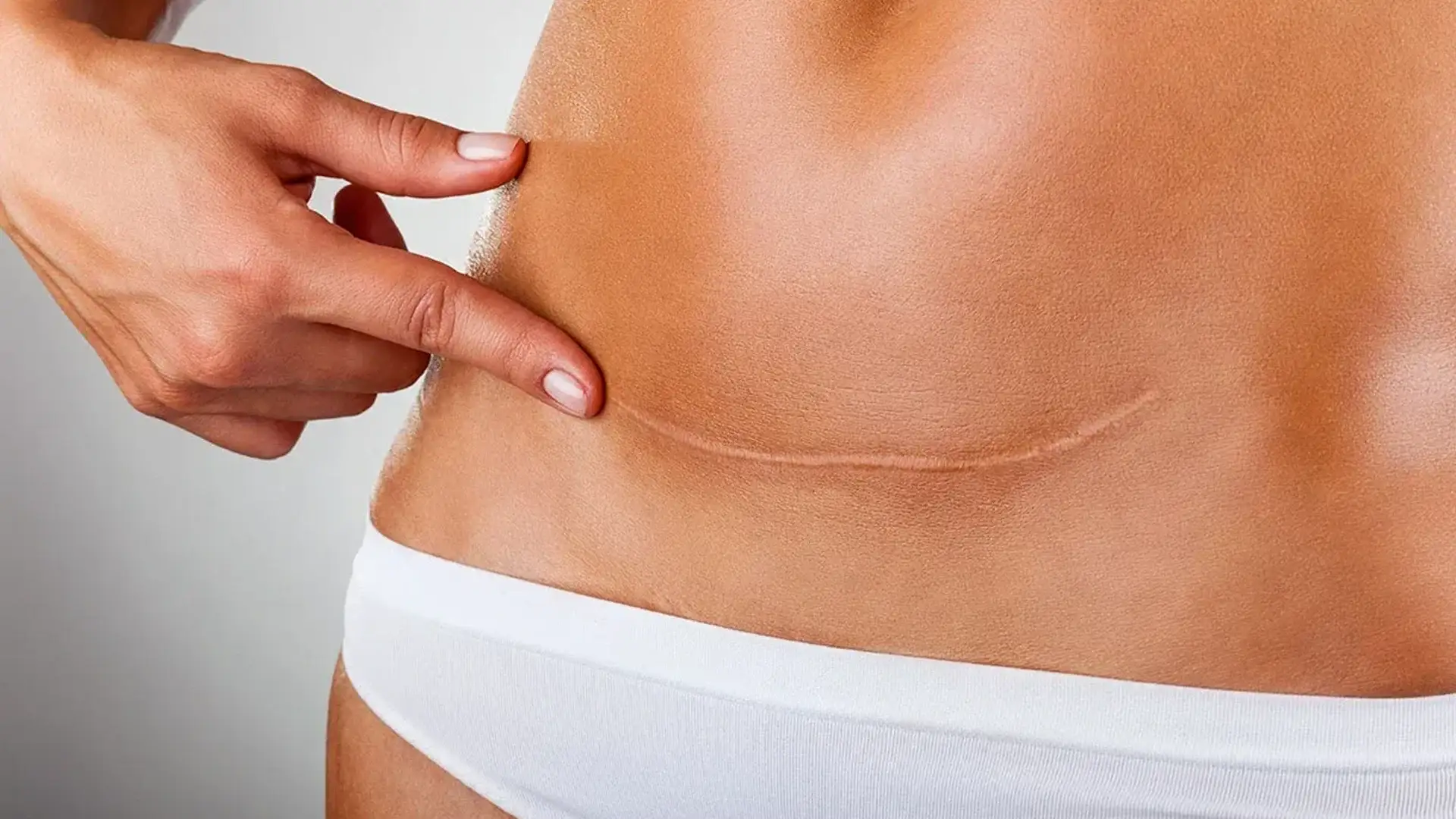 jak-dlugo-do-chirurgii-tummy-tuck