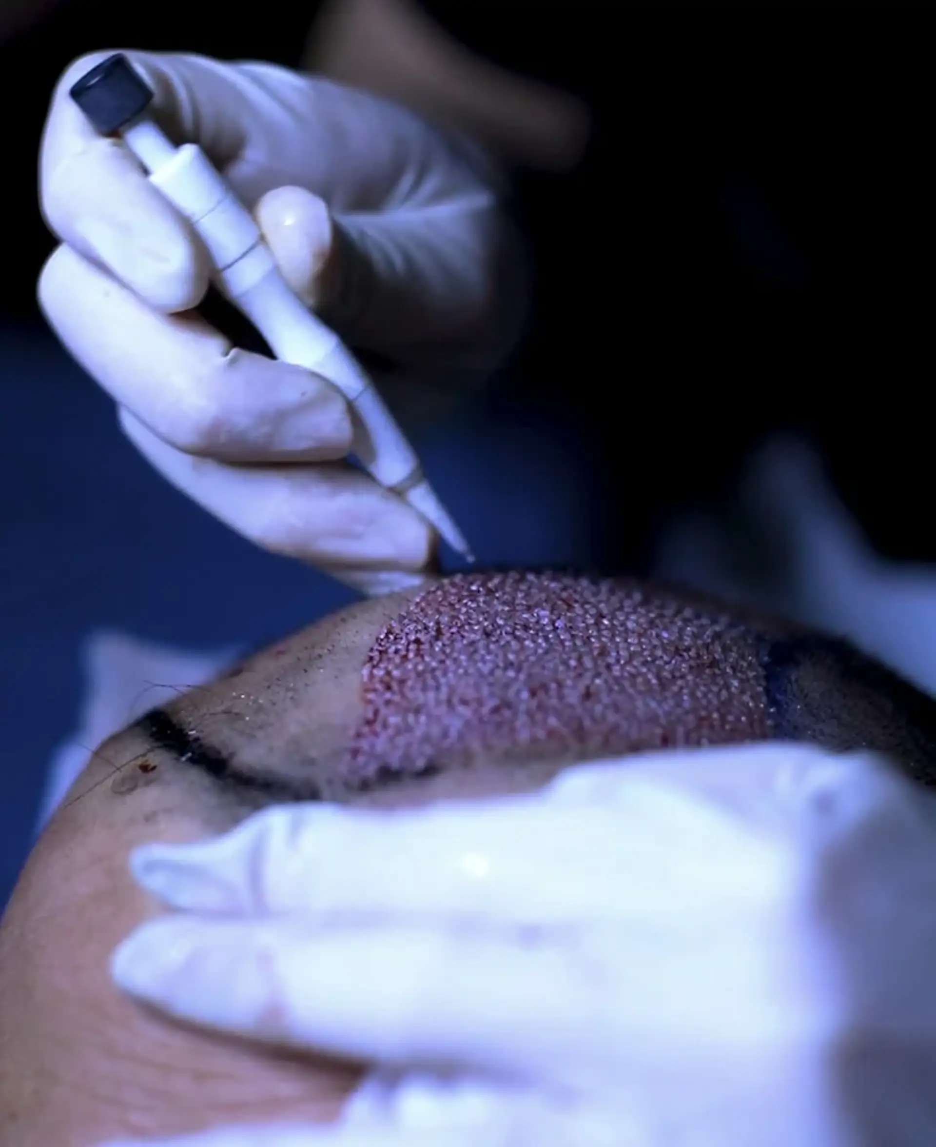 planning-your-hair-transplant-journey