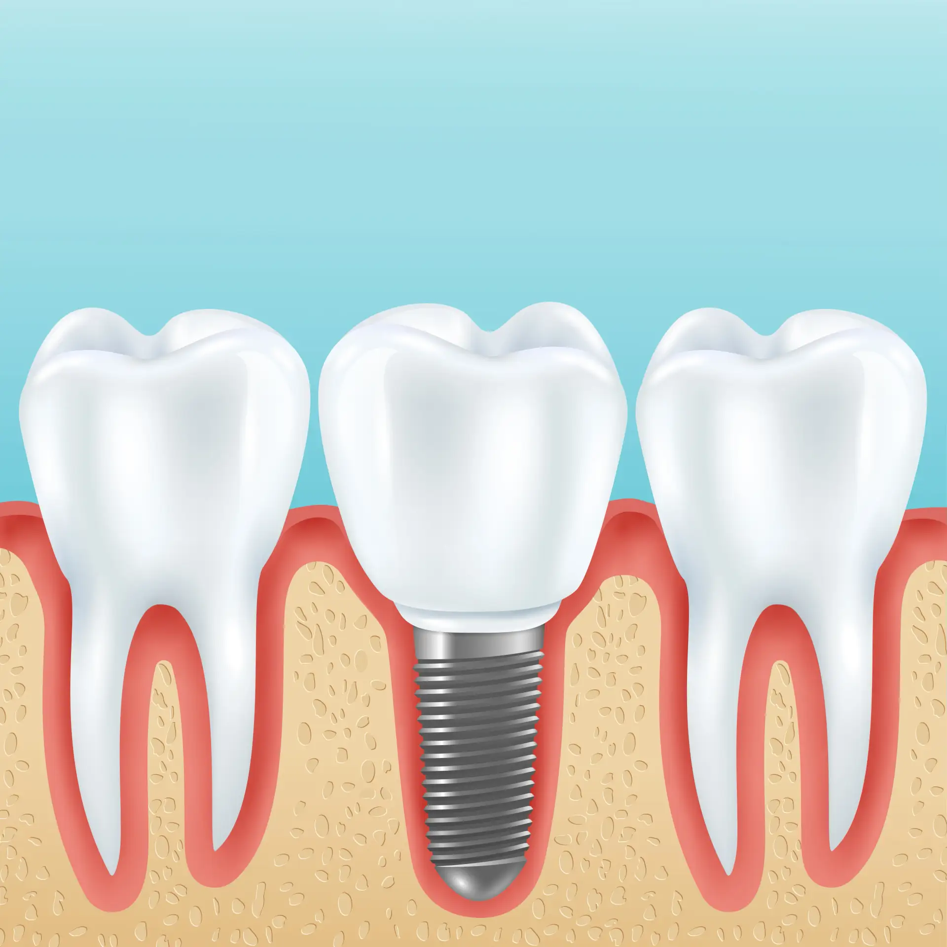 implanty dentystyczne