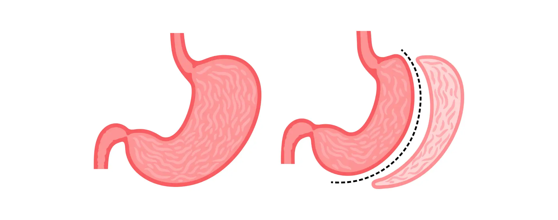 pacjenci-benefit-from-sleeve-gastrektomia