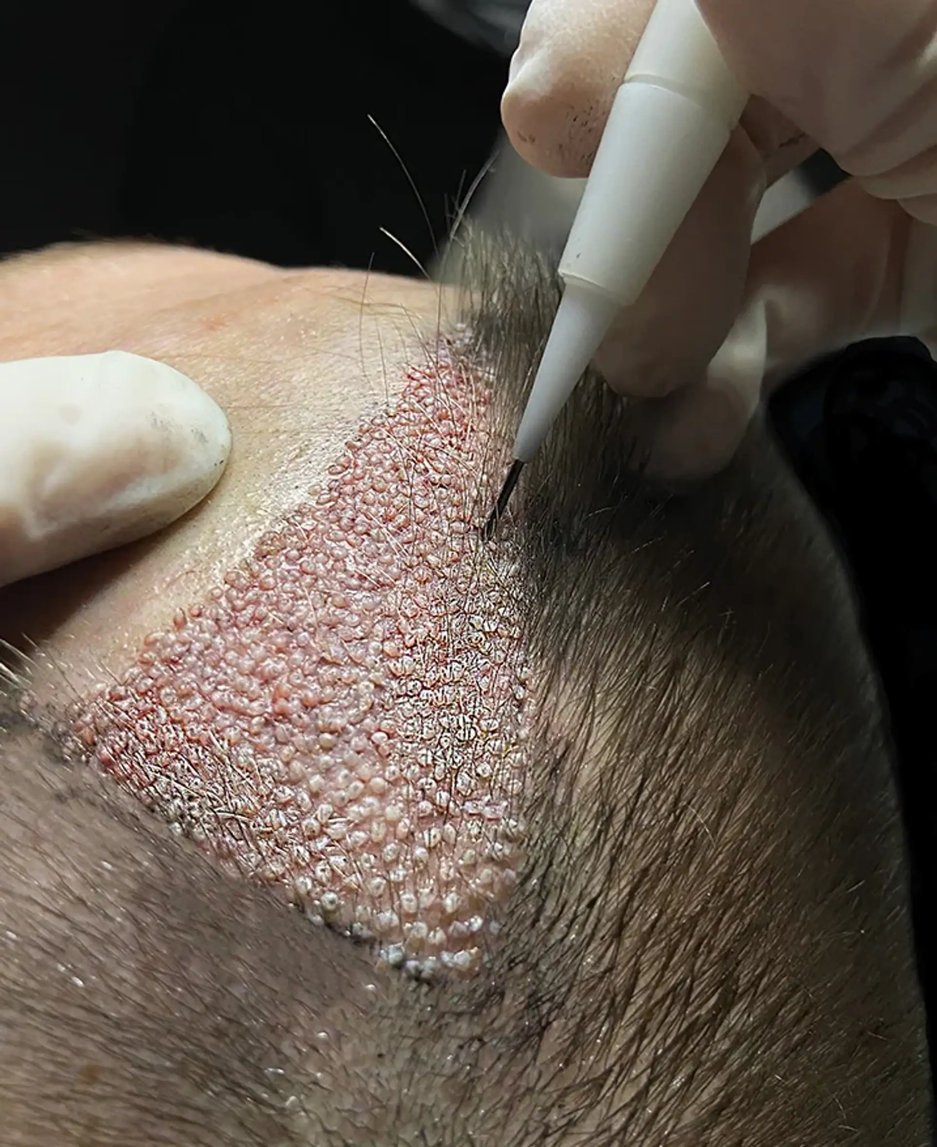 how-much-does-hair-transplant-cost-in-tirana