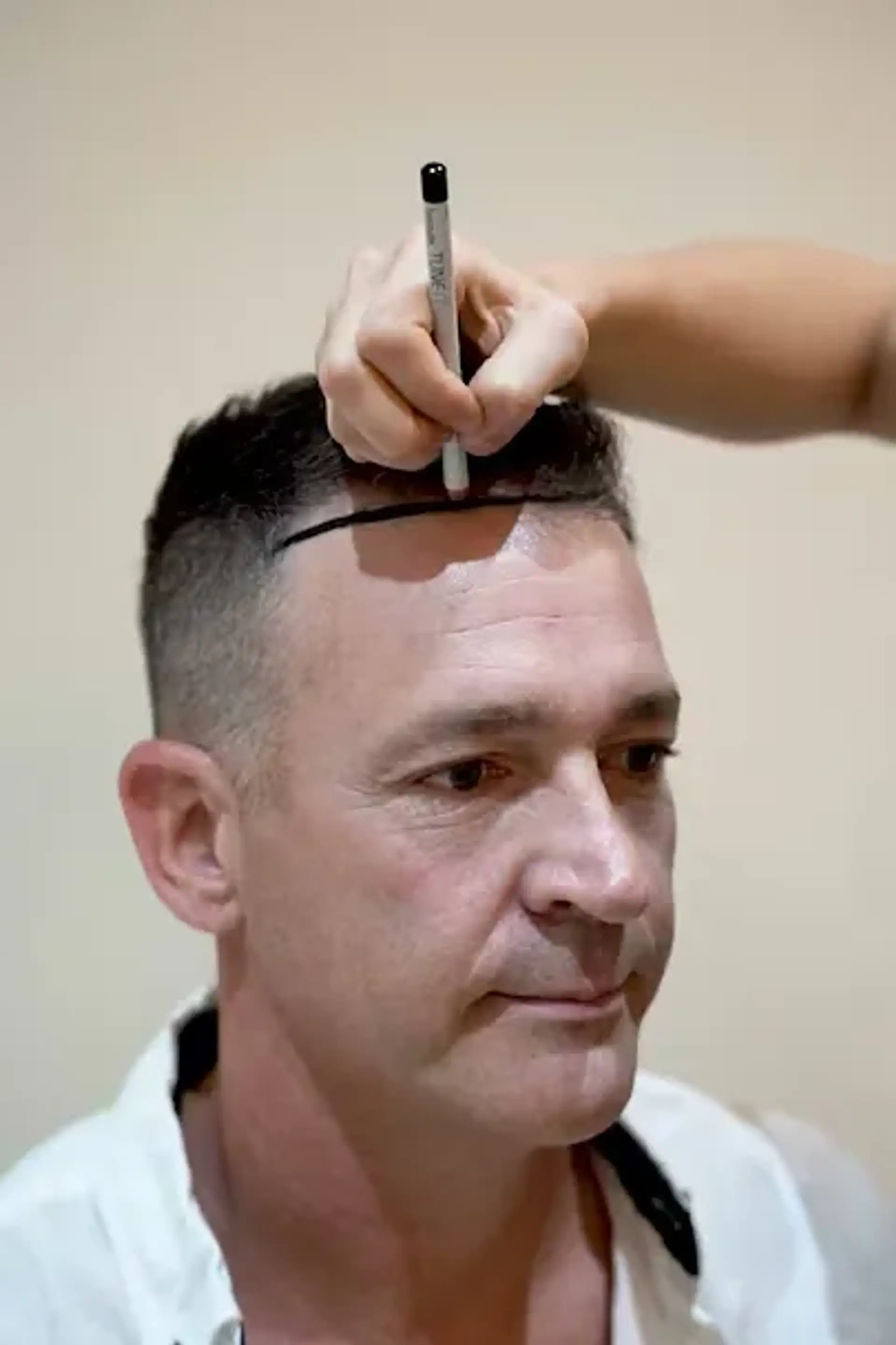 hairtransplantresults-royal