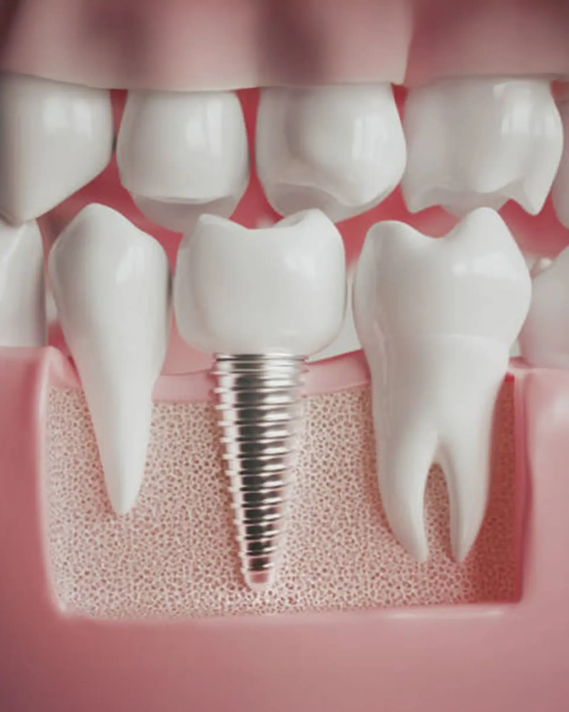 implant-treatment