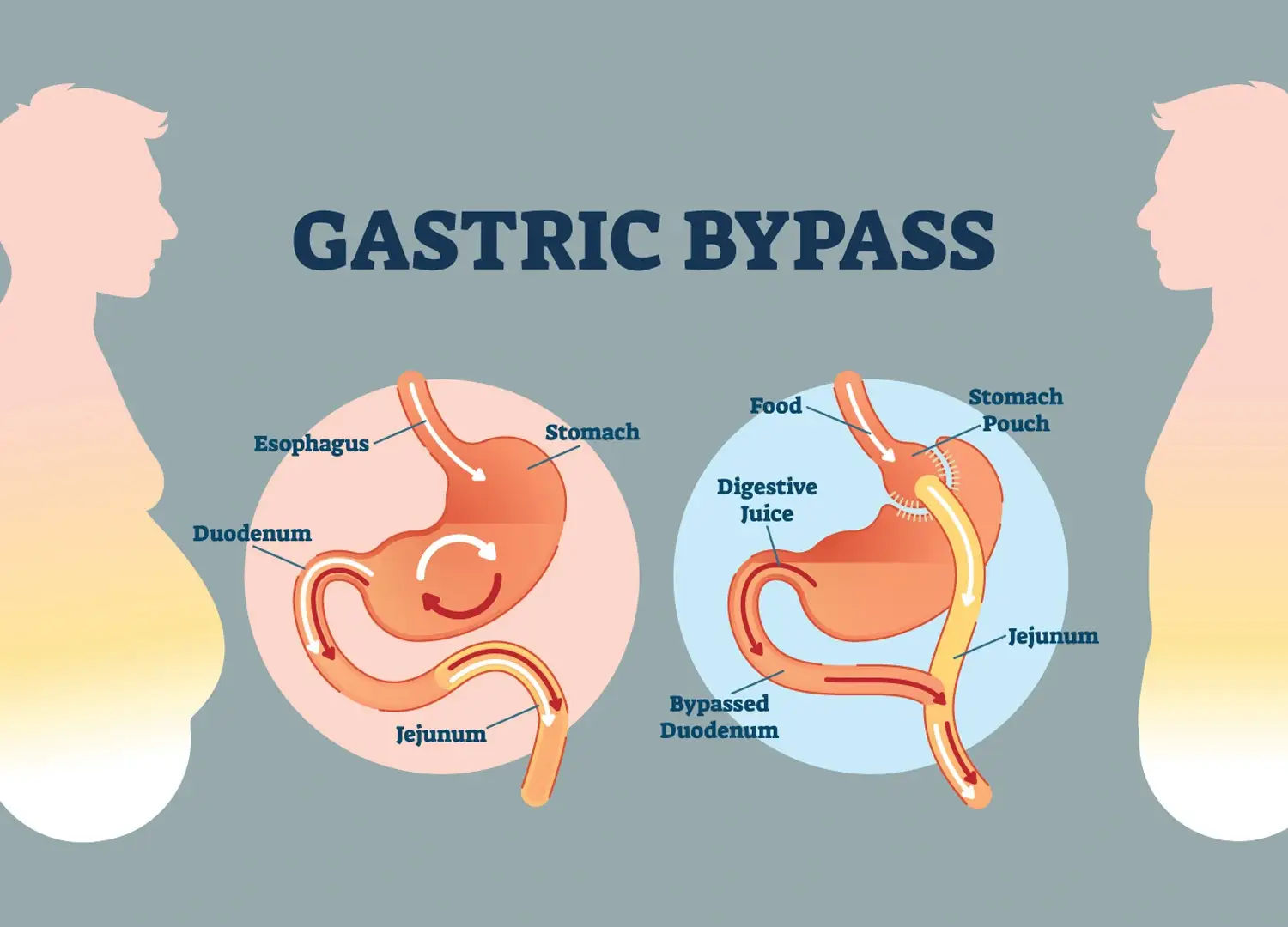 obésité-alternatives-à-la-chirurgie-de-bypass-gastrique