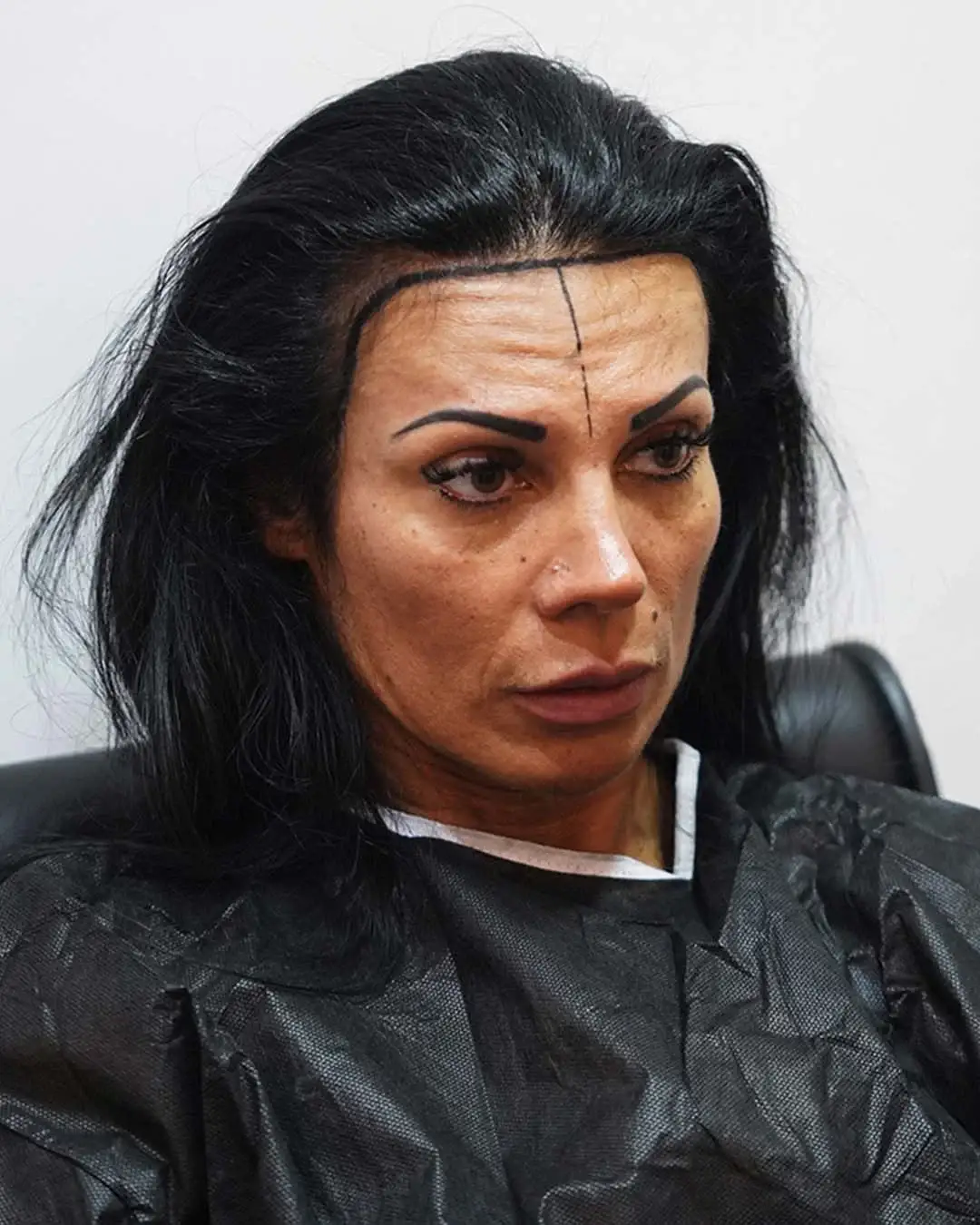 Royal-Hair-Frauen-Haartransplantation