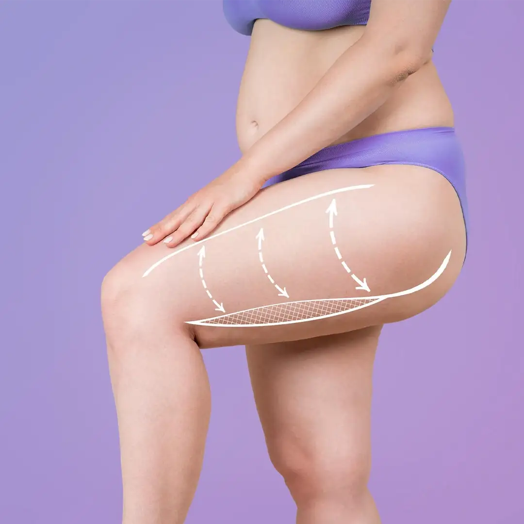 que-é-bom-candidato-coxa-levantamento-cirurgia