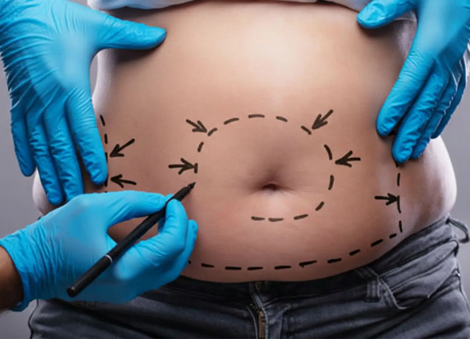 mega-liposukcja-czego się spodziewać w dniu-wysokiego-bmi-liposukcja-chirurgii