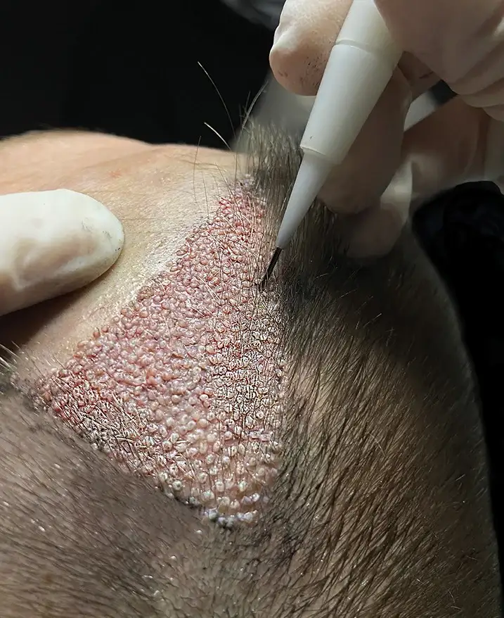 how-much-does-hair-transplant-cost-in-tirana