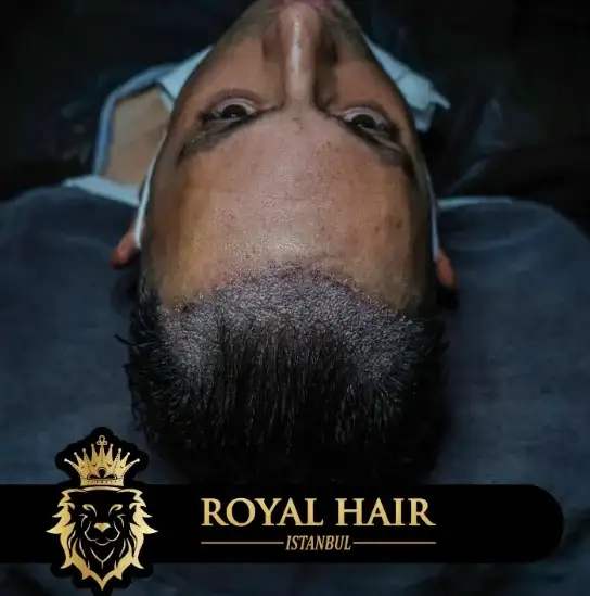 Understanding Hair Transplant Cost in Albania: Affordable Solutions for Hair Restoration