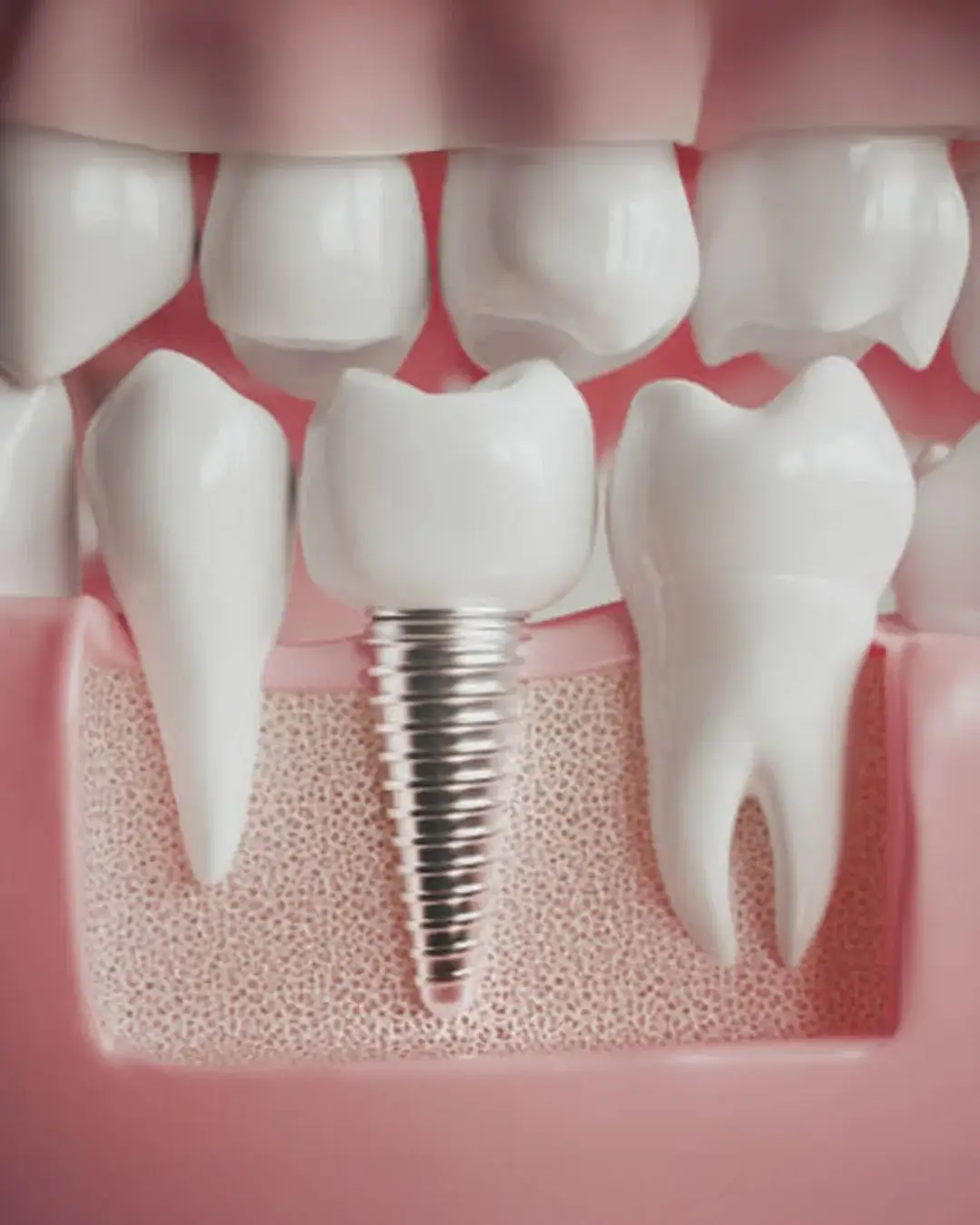 implant-treatment