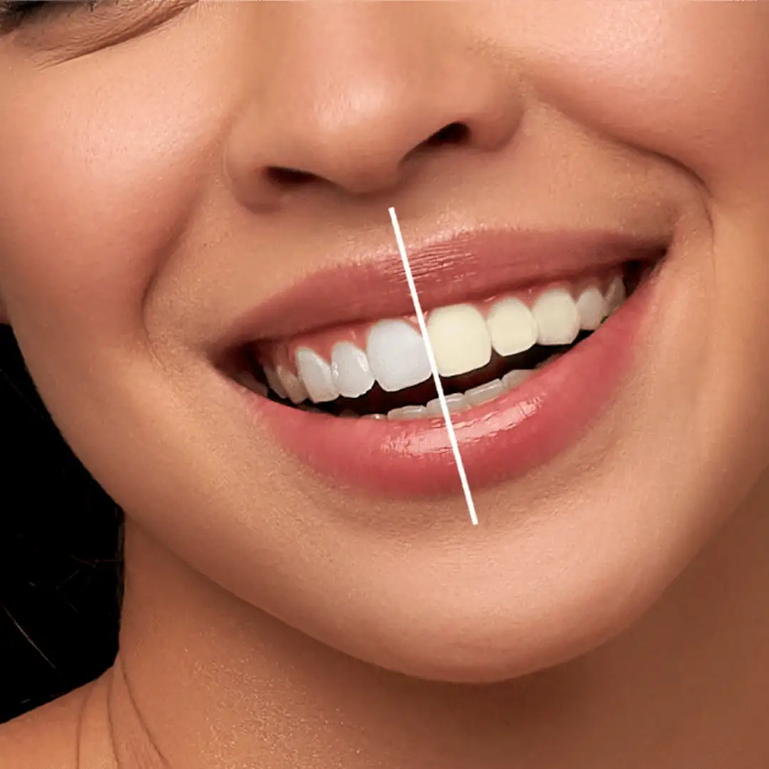 teeth-whitening