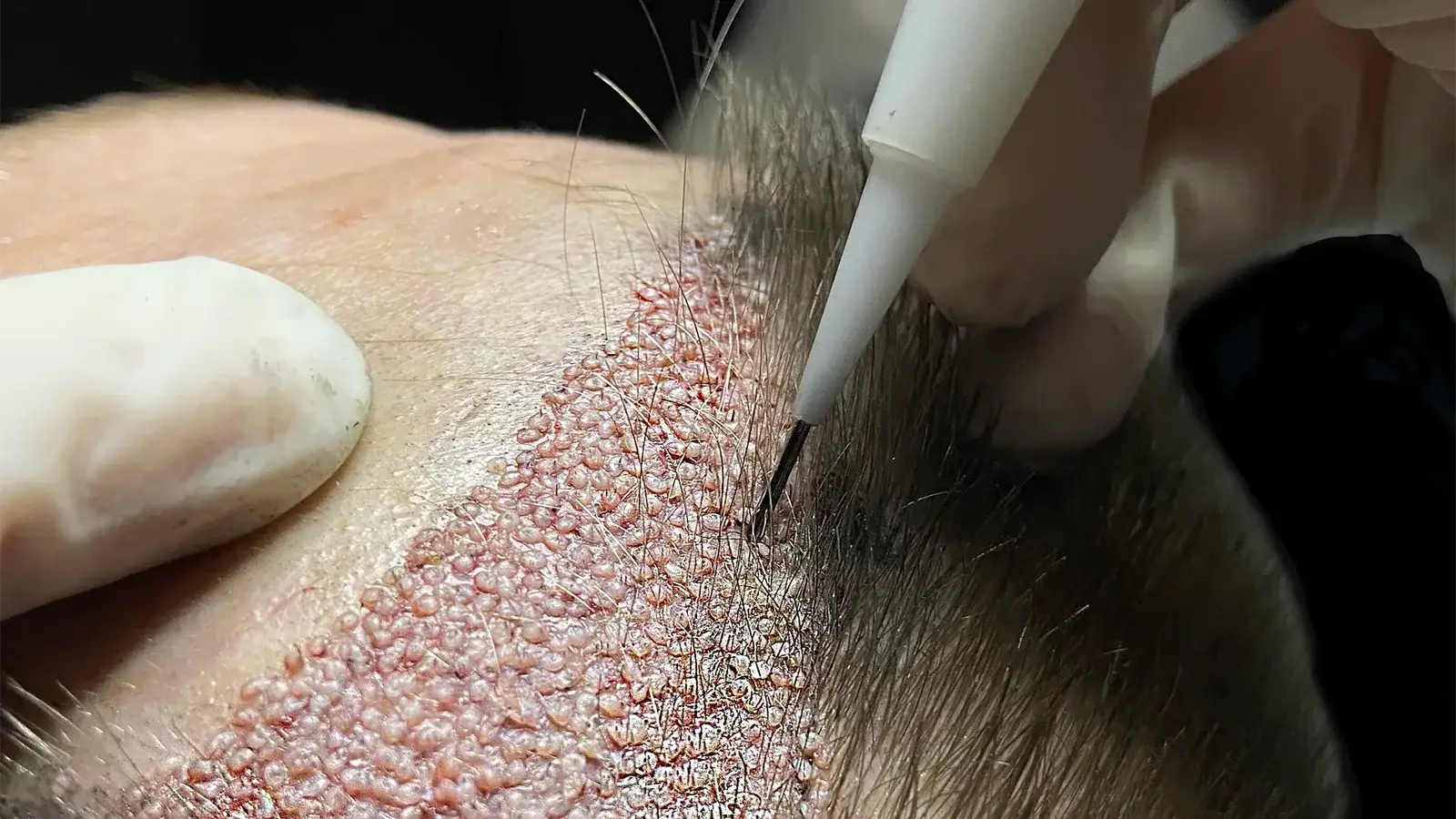 Hair Transplant in Istanbul: FUE/DHI Prices and Techniques
