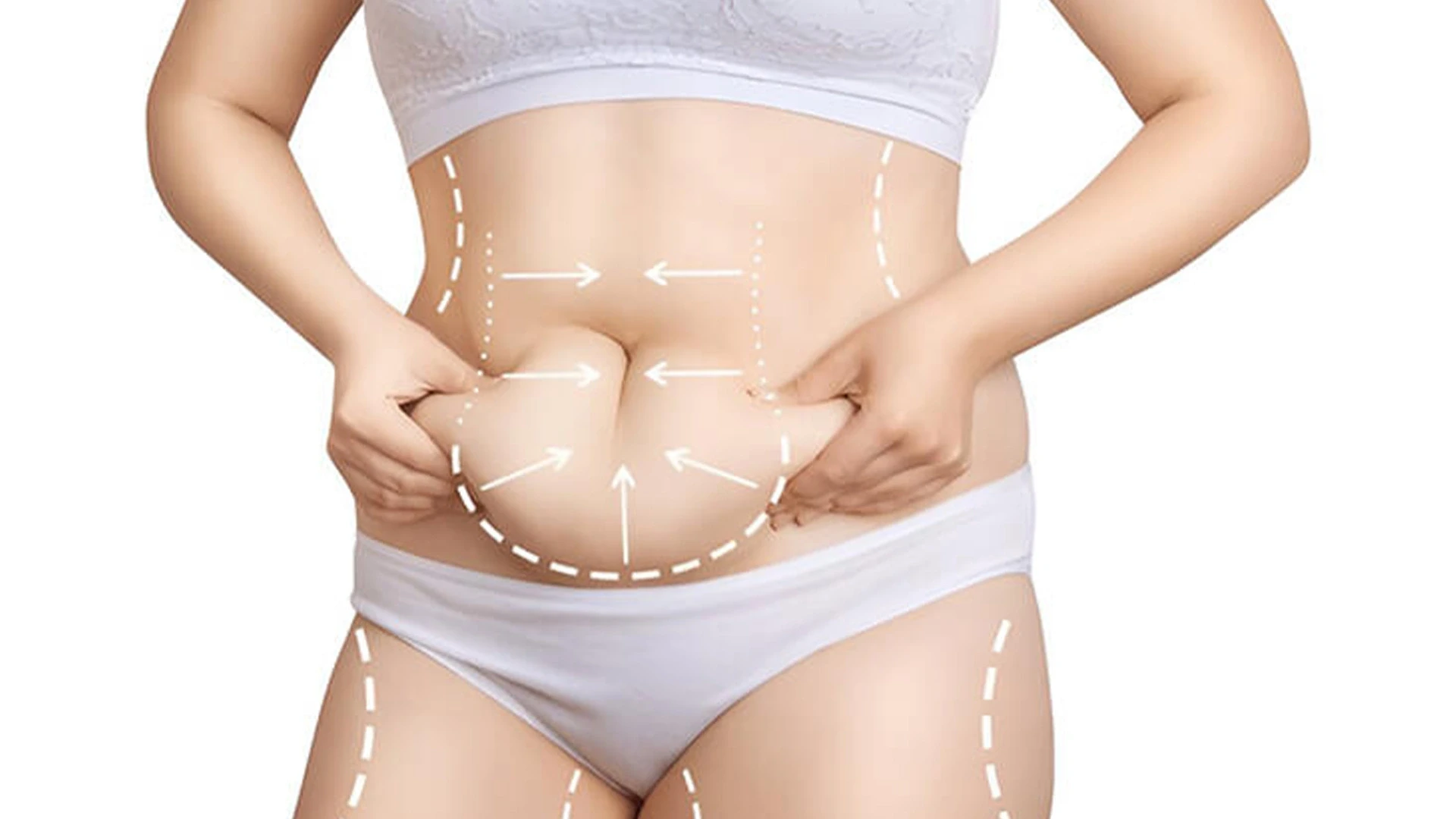 mega-liposuzione-cosa-aspettarsi-il-giorno-dell-intervento-di-liposuzione-ad-alto-bmi-