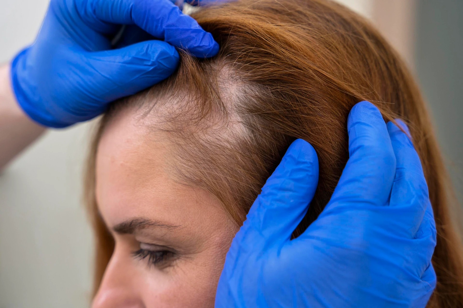 clinica-trattamento-perdita-capelli-donna