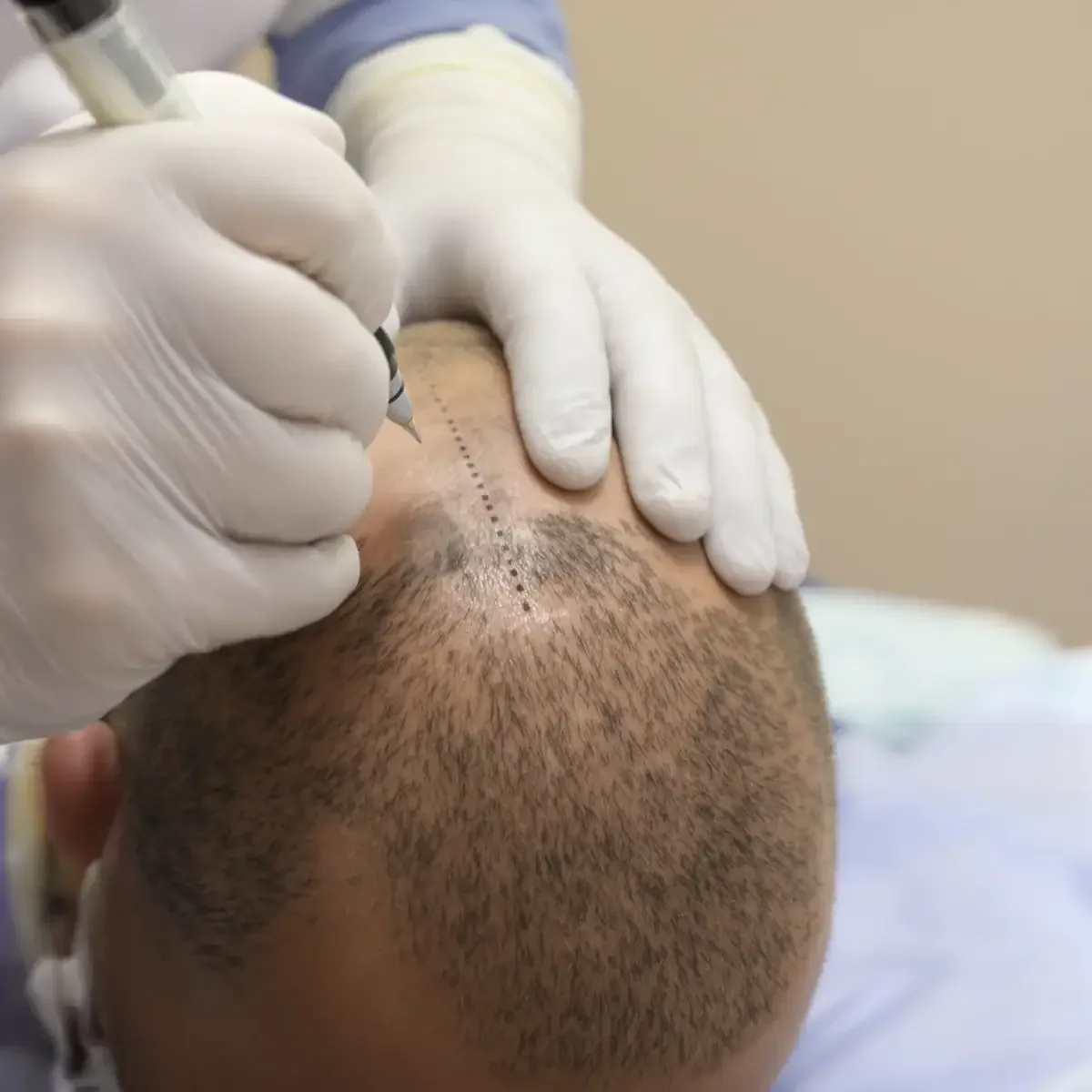 Surgeon marking a patient