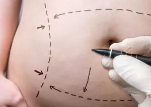 Chirurgie de l'abdomen Image Copyright : https://www.agulloplasticsurgery.com/