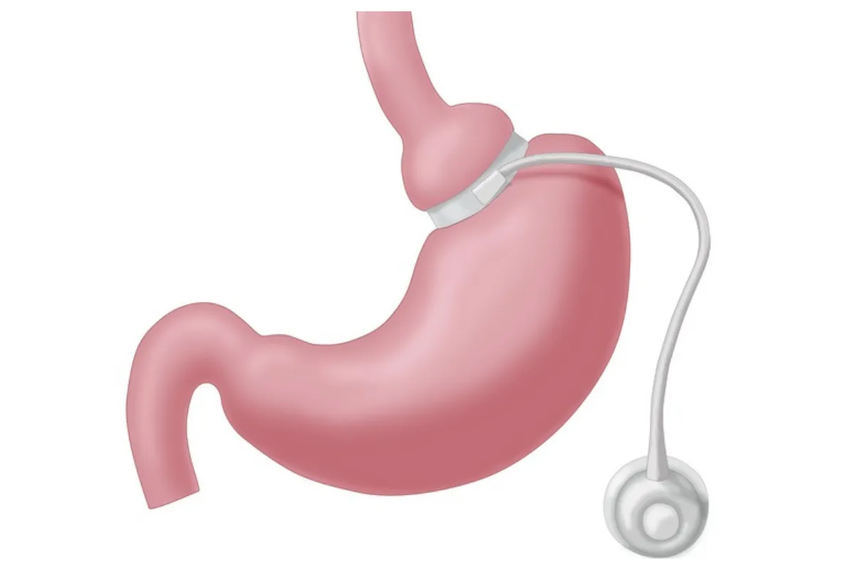 Lap-Band Removal Surgery: Gastric Band Removal in Mexico