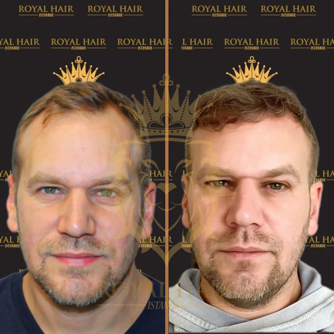 Before and After Hair Transplant