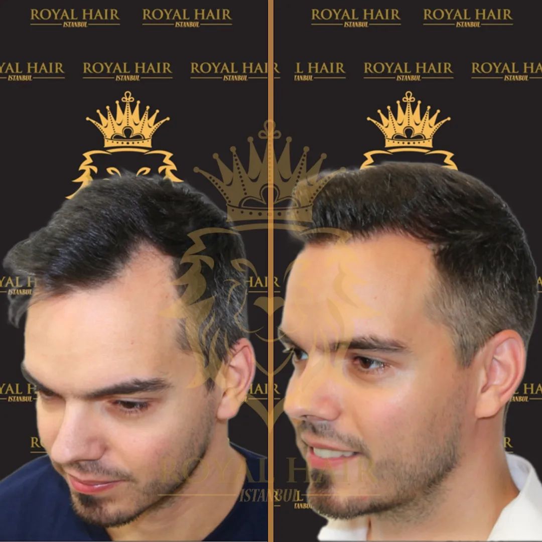 Before and After Hair Transplant