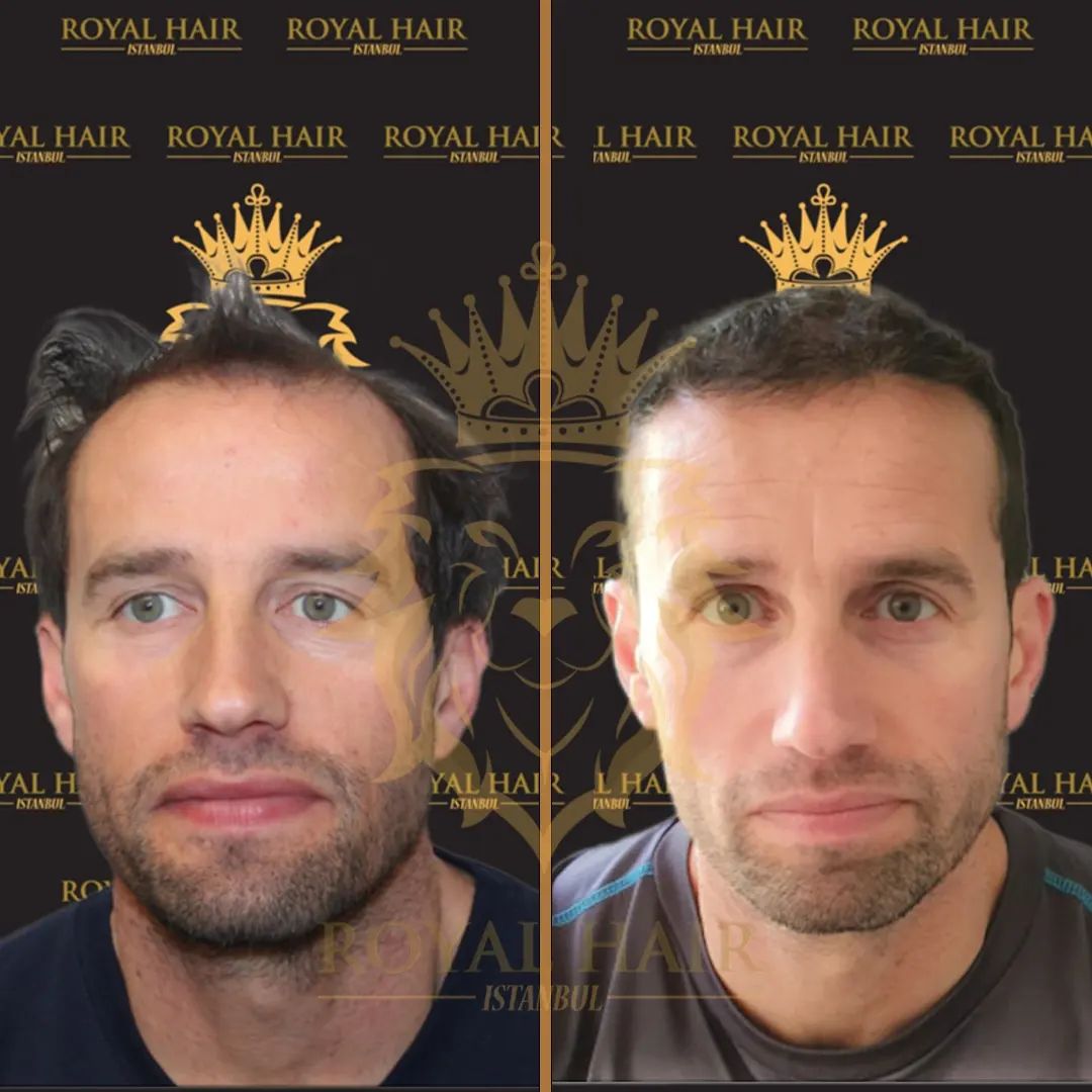 Before and After Hair Transplant