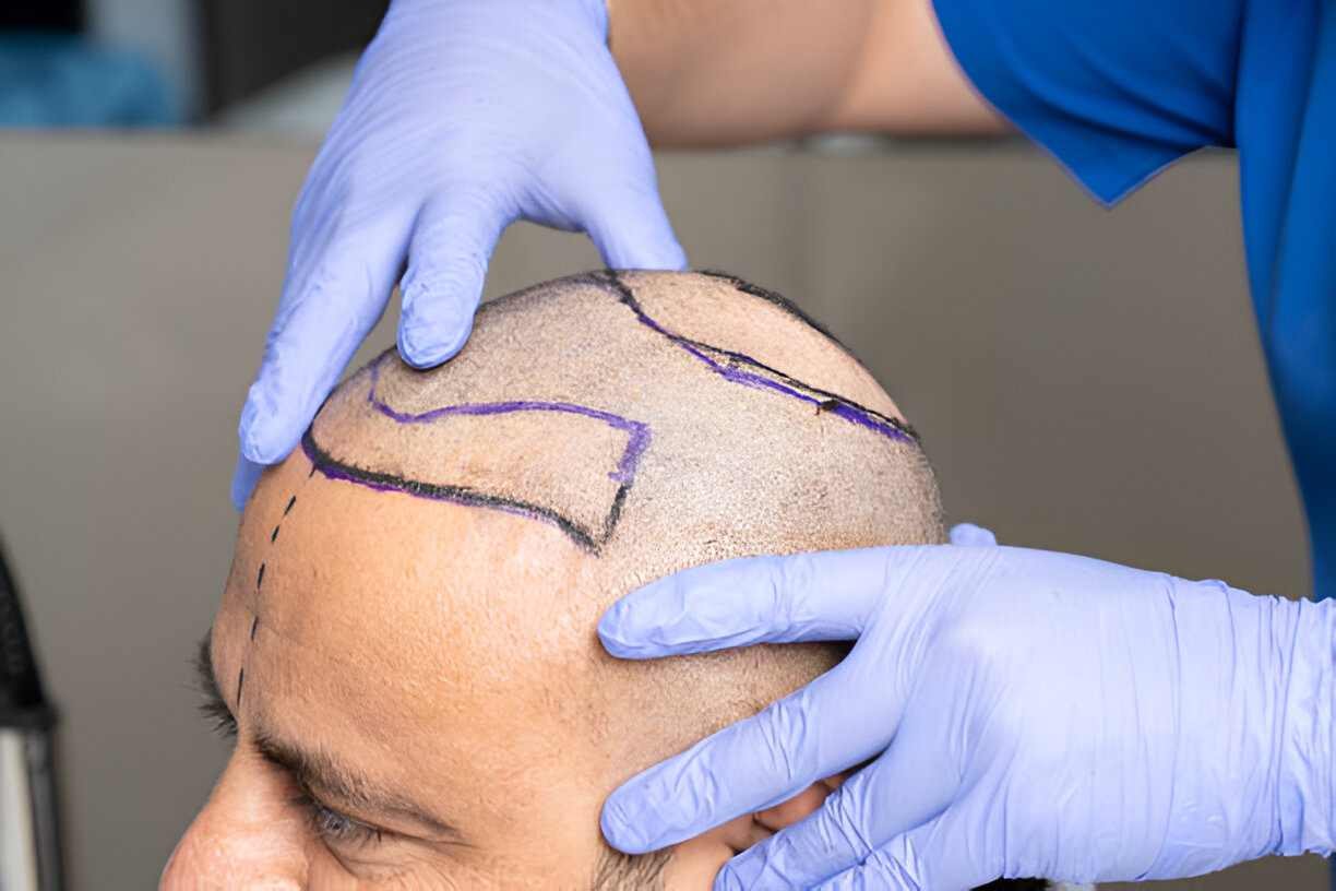 Hair Transplant in Turkey