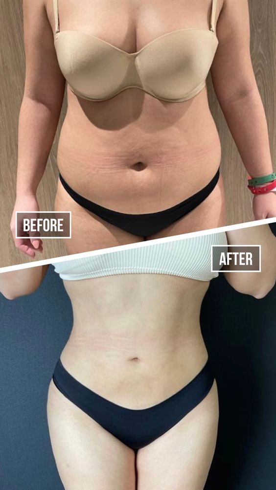 Liposuction in Turkey: Everything You Need to Know Before Getting the Procedure