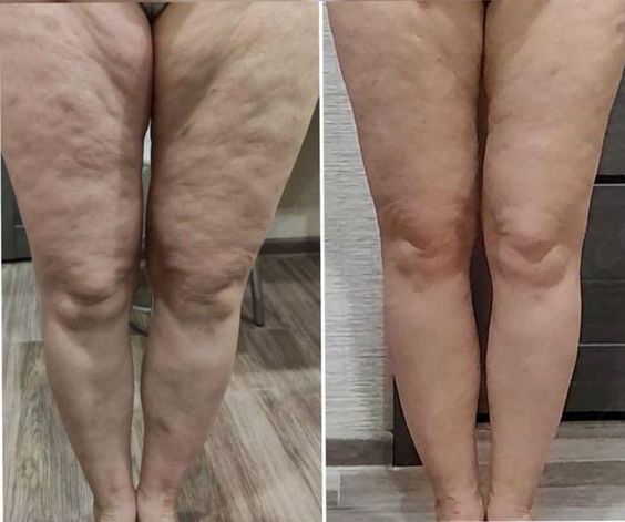 Thigh Lift in Turkey – Affordable, High-Quality Transformation for Smoother, Toned Thighs