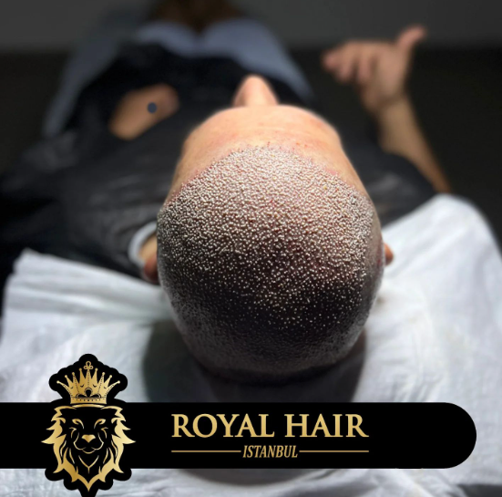 Discover everything you need to know about hair transplants and hairline lowering procedures to boost your confidence.