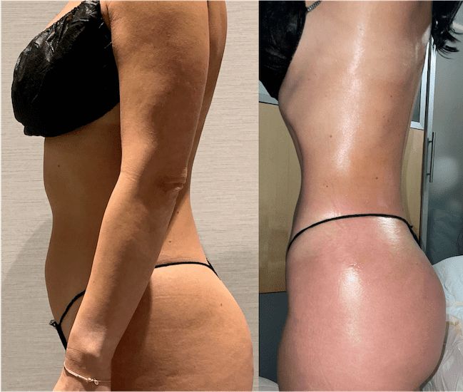 Explore the benefits of Mega Liposuction in Turkey: cost-effective, advanced techniques, and top clinics for a sculpted body.