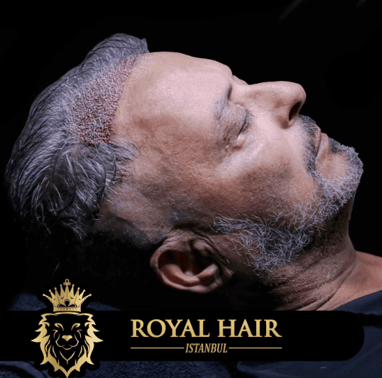 Explore hair loss treatments in Albania, including options, costs, and benefits. Discover how to regain your confidence and choose the right solution for you.