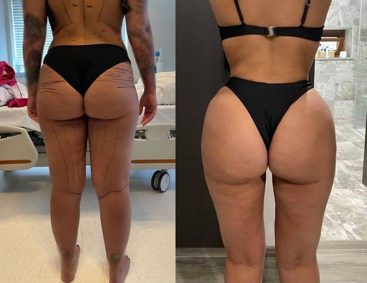 Discover everything about getting a Brazilian Butt Lift (BBL) in Turkey, from costs to top clinics and recovery tips.